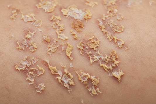 Pemphigus Foliaceus: Understanding This Rare Autoimmune Skin Condition With Compassion + Clarity